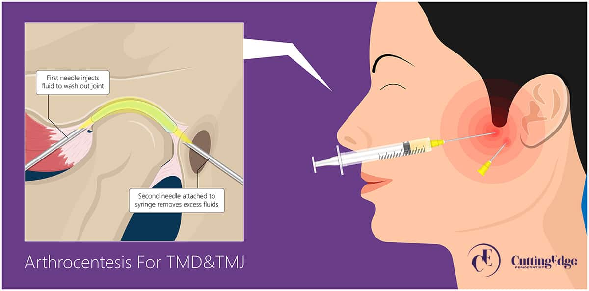 TMD surgical treatment option: Arthocentesis