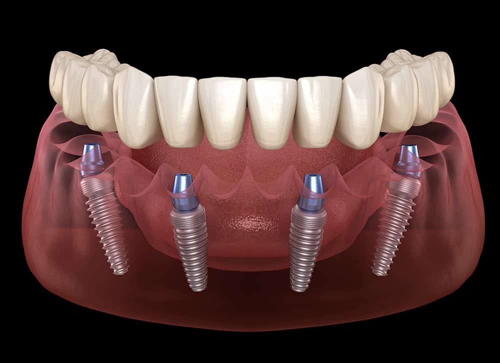 Cutting Edge Periodontist - Dental Implants