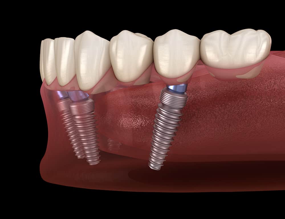 All On 4 Dental Implants - Burbank Periodontist