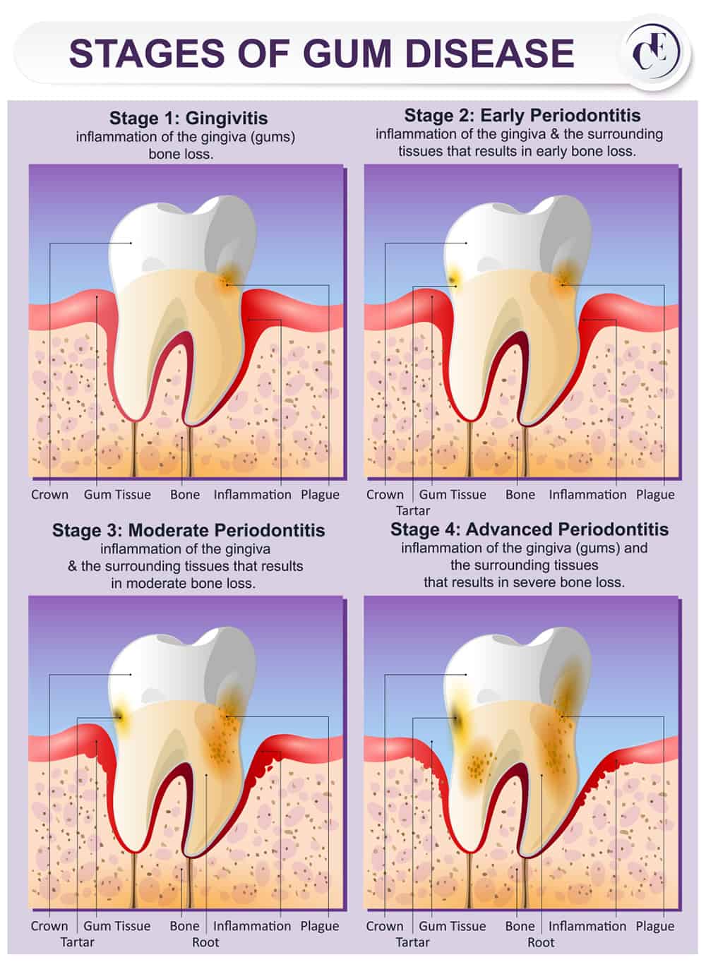 Stages of Gum Disease - Cutting Edge Periodontist