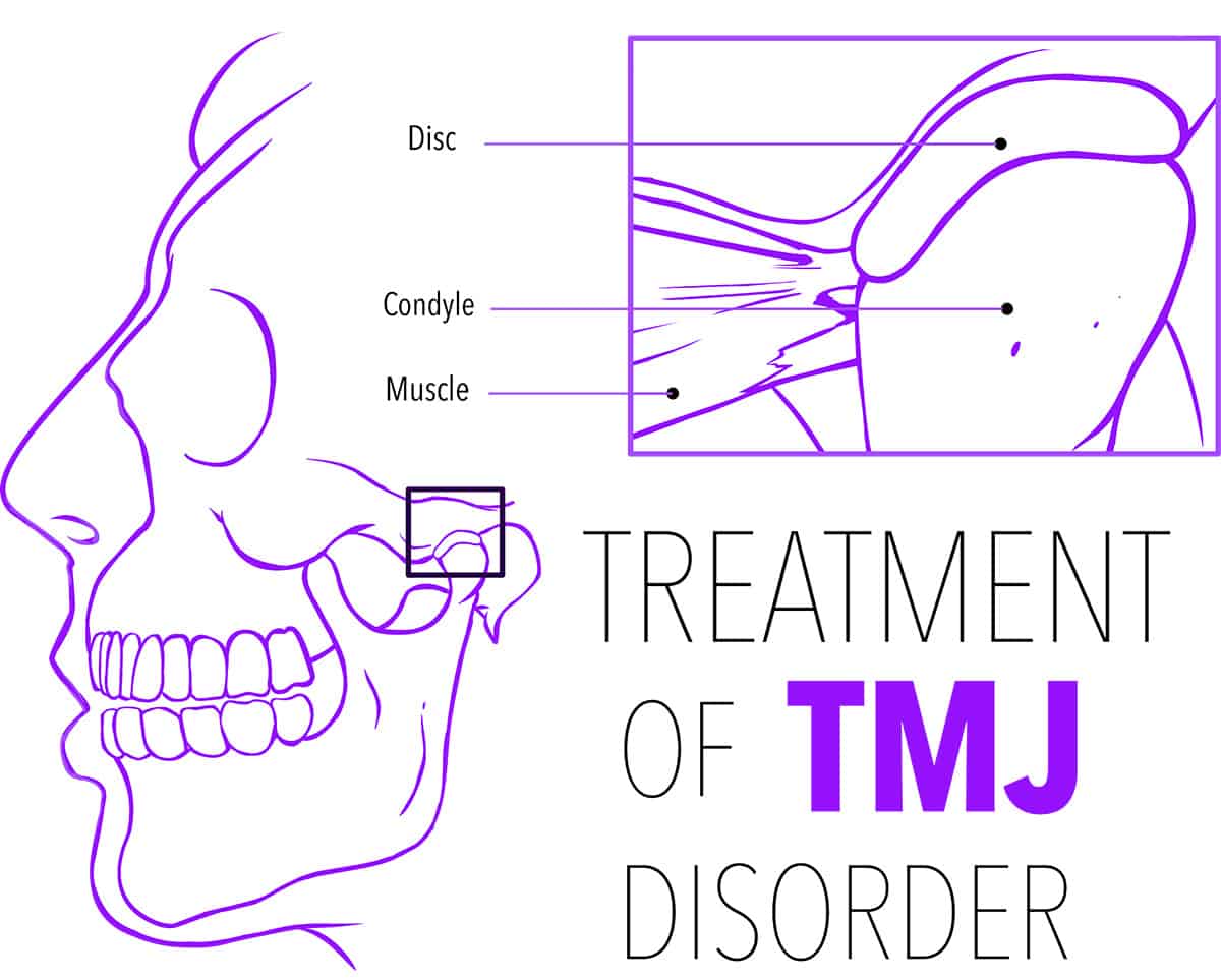 TMJ Illustration - Cutting Edge Periodontist - Burbank, CA