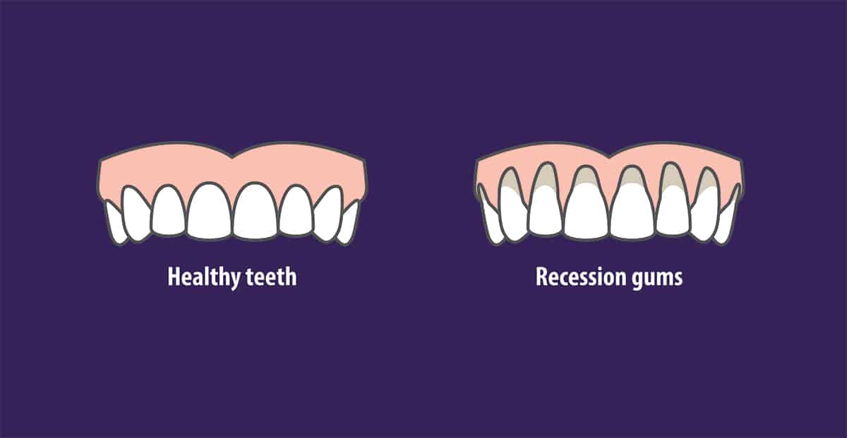 What Is Gum Recession? - Periodontist Burbank