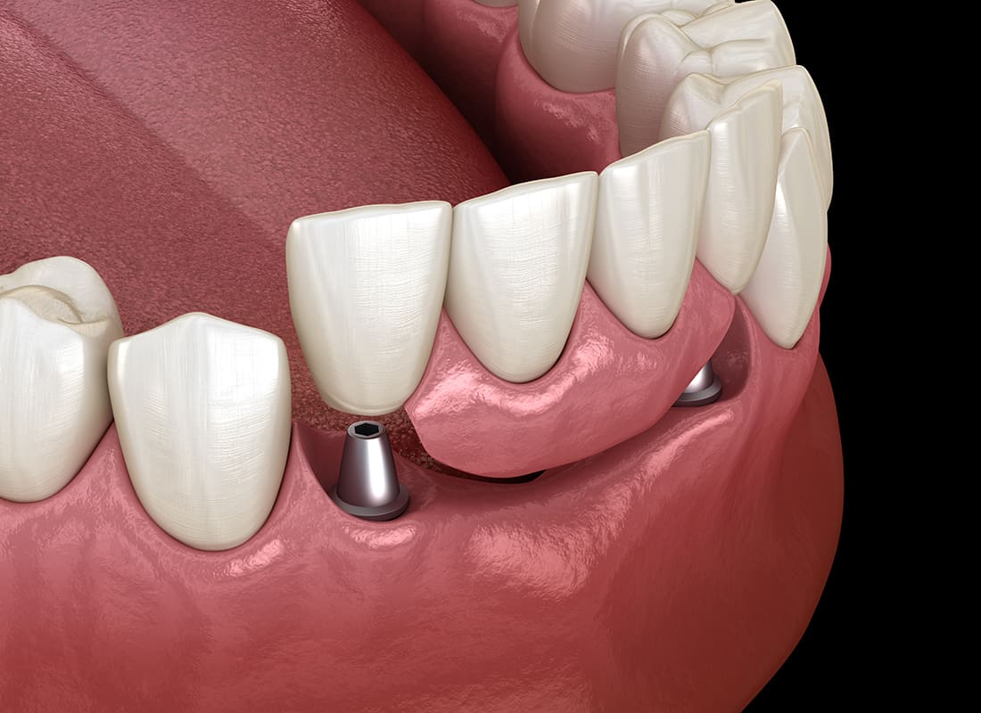 Implant supported bridge by Burbank Periodontist