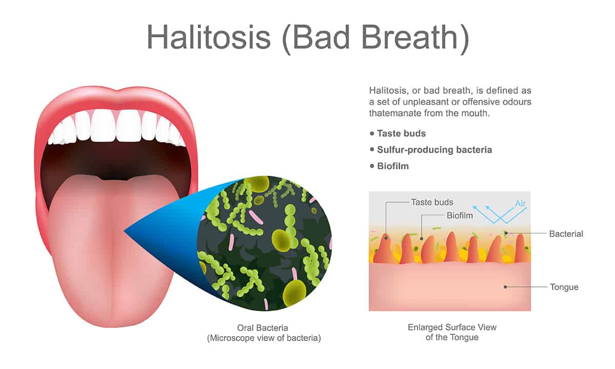 Halitosis - Bad Breath