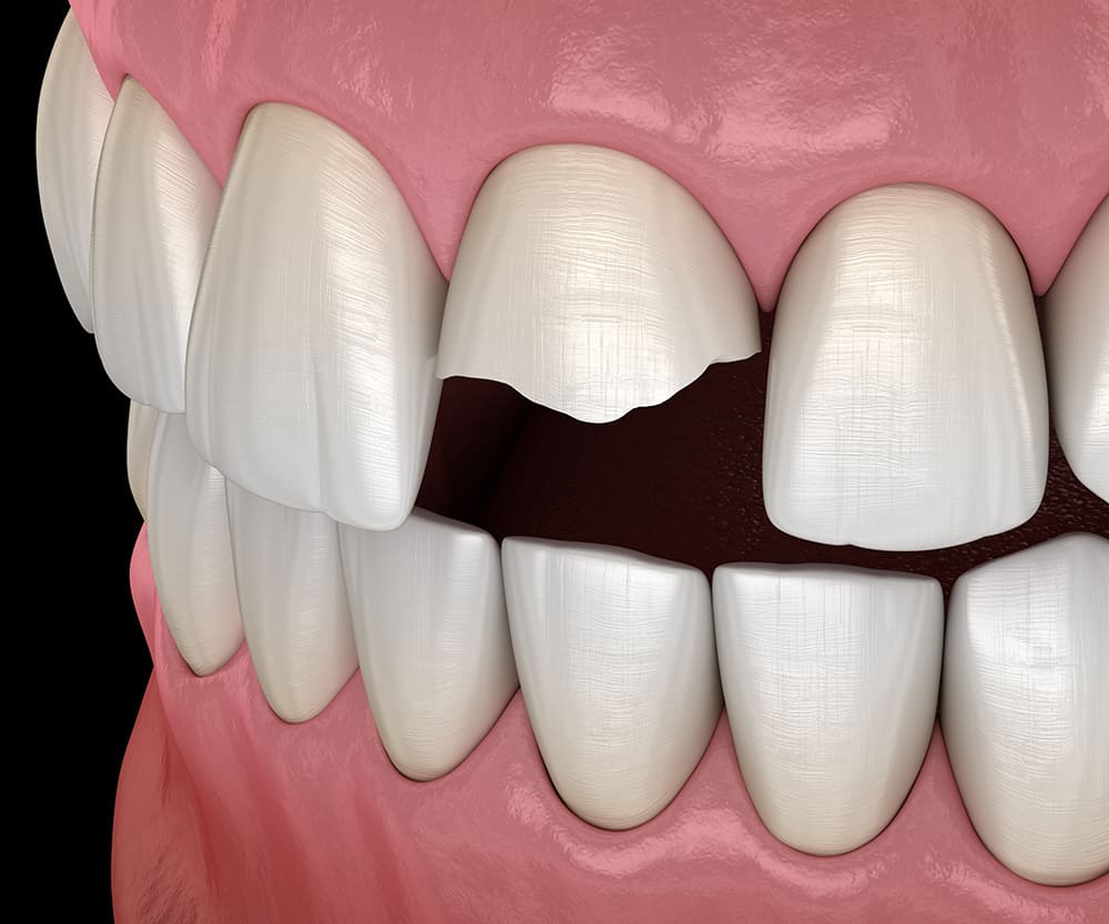 Broken Tooth - Glendale, Burbank, Toluca Lake Periodontist