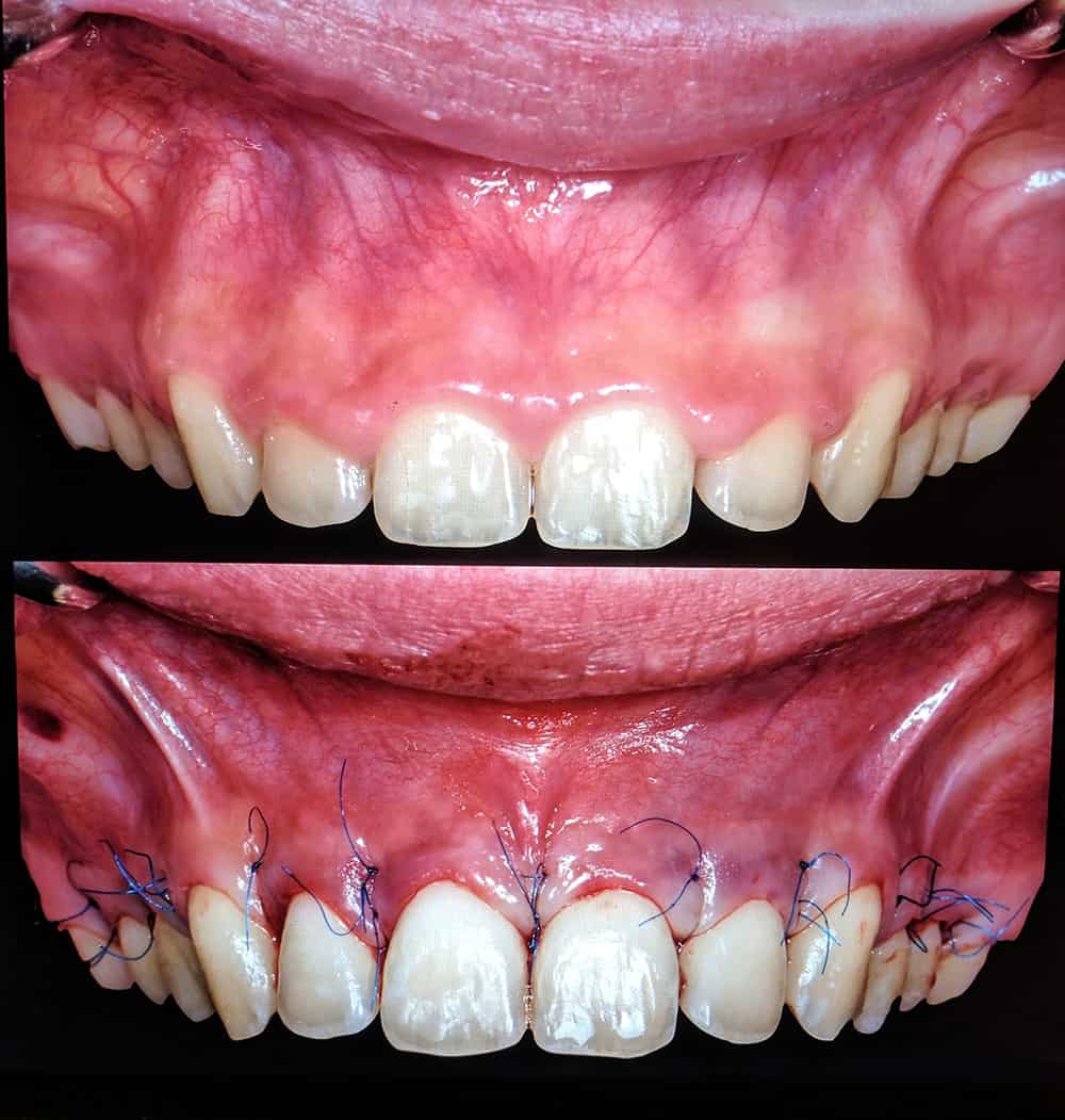 Gummy Smile Before and After Stiches - Cindy Case Study