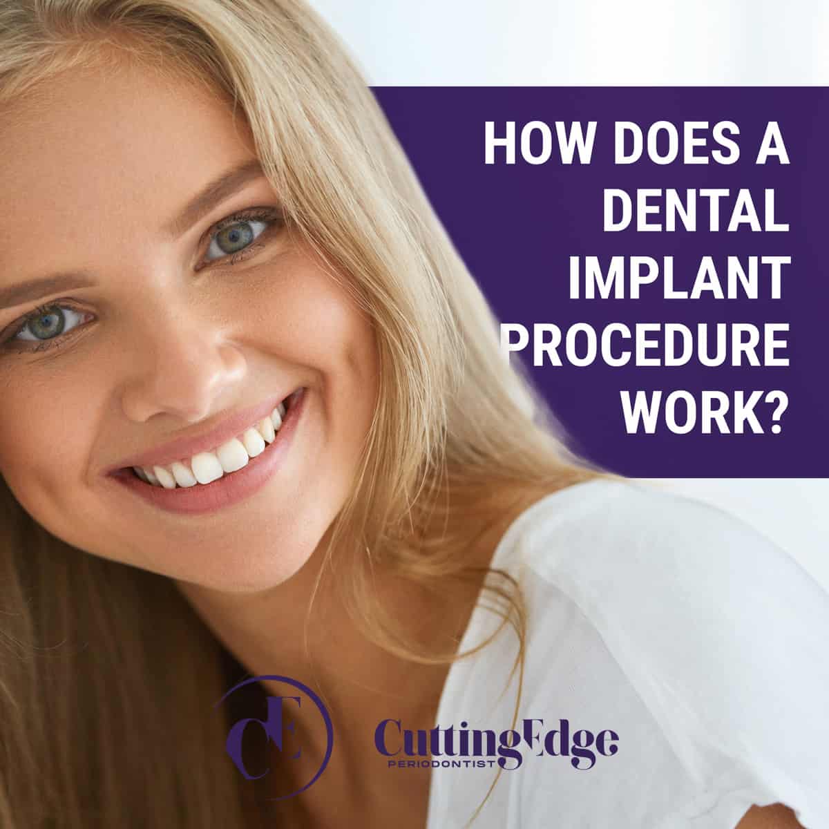 Which Dental Implant Is Right for Me?
