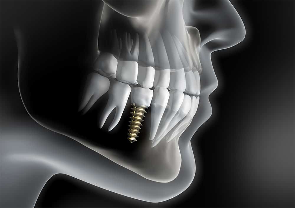 Dental Implants - Burbank, Glendale, Toluca Lake, CA