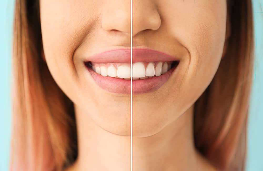 Gum reshaping - Gingivectomy - Gummy Smile