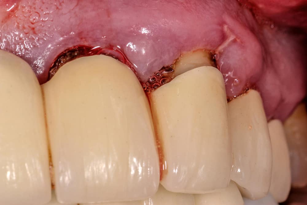 Severe Periodontitis with additional tooth loss