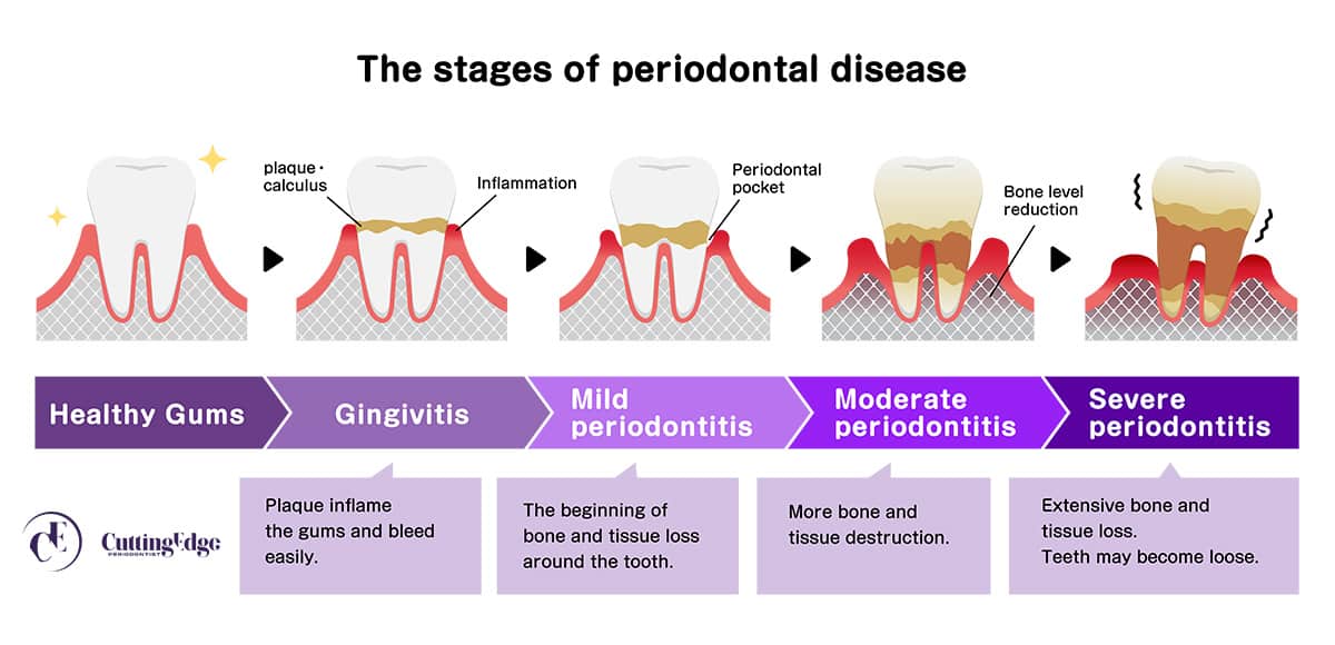 Stages of Periodontitis