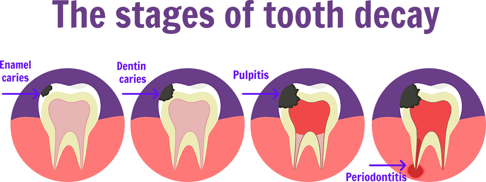 Stages of Tooth Decay - Burbank Tooth Extraction