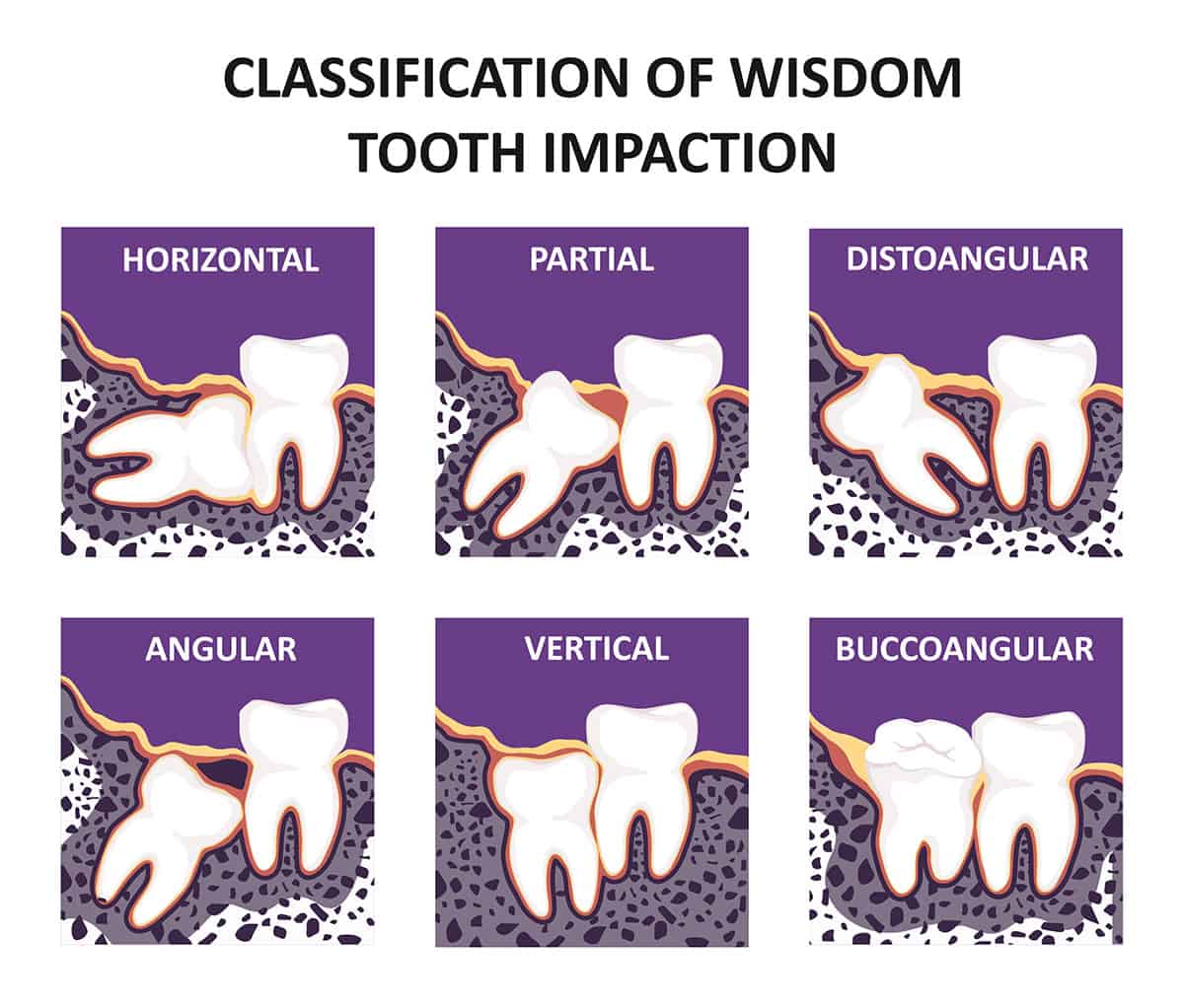 Tooth Impaction - Wisdom Tooth Removal