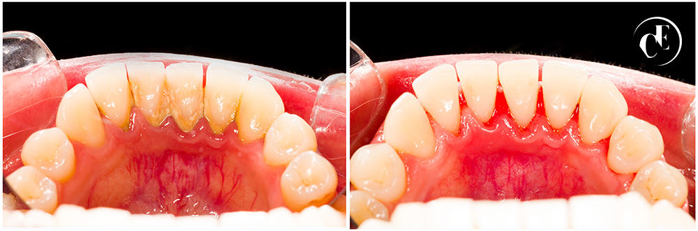 Tooth Scaling - Glendale, Burbank Periodontist