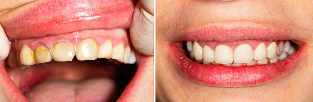 Worn Teeth - Before and After
