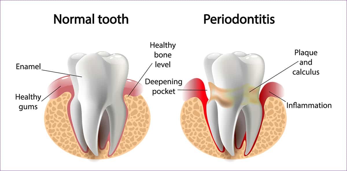 Periodontitis - Cutting Edge Periodontist - Glendale, Burbank
