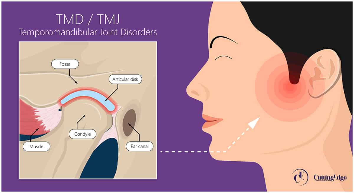 TMD - Cutting Edge Periodontist - Burbank - Glendale