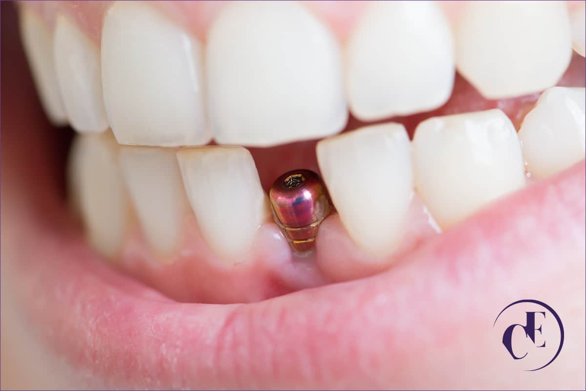 Why You Should Choose Dental Implants - Cutting Edge Periodontist - Glendale, Burbank