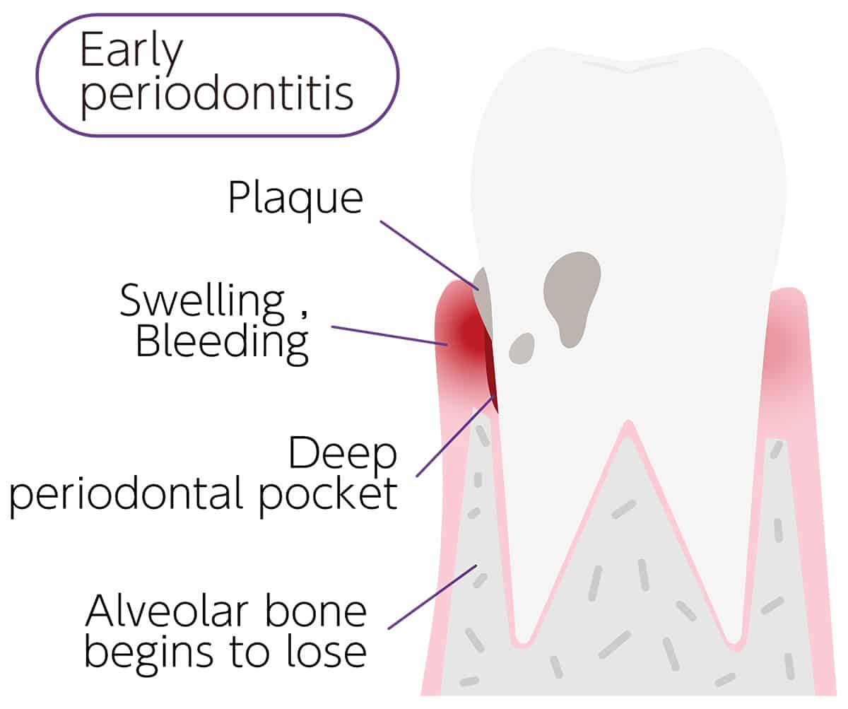 4 Stages of Periodontal Disease - Cutting Edge Periodontist - Burbank, CA