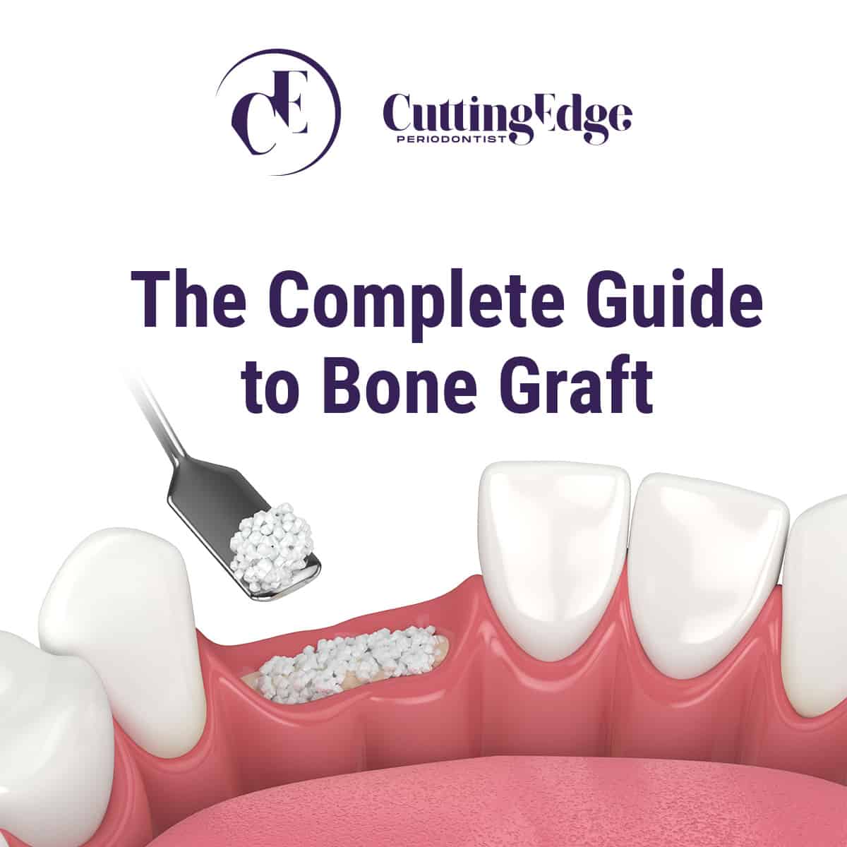Bone Graft - Cutting Edge Periodontist, Burbank, CA