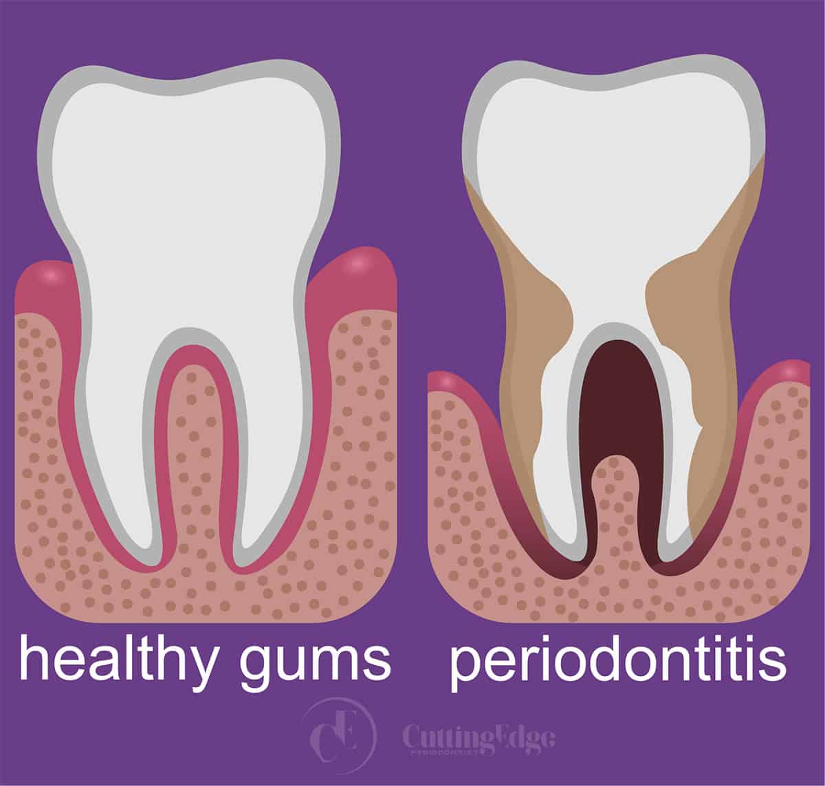 Healthy Gums vs Unhealthy Gums - Cutting Edge Periodontist - Burbank CA