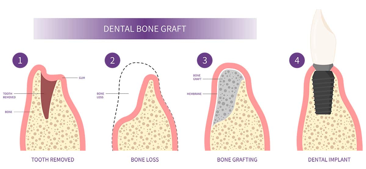 Dental Bone Graft - Cutting Edge Periodontist, Burbank, CA